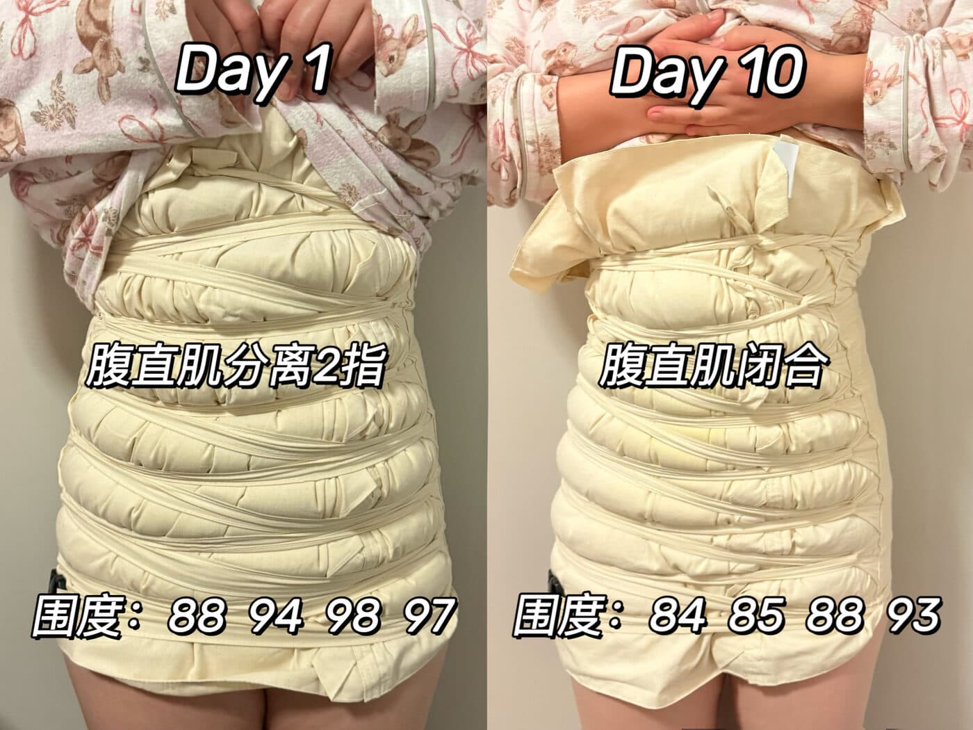 同一位妈妈扎肚第 1 天与第 10 天的对比