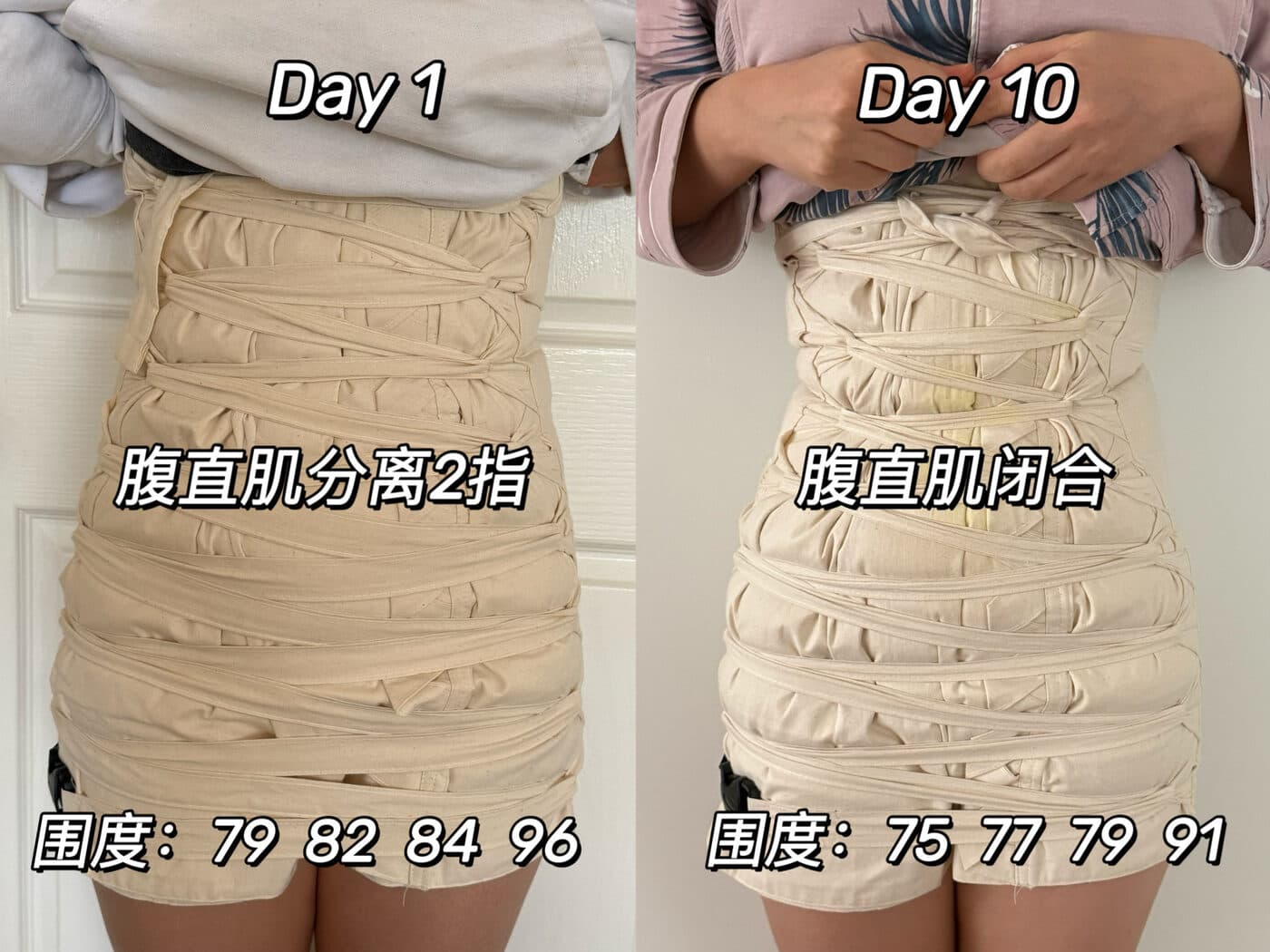 同一位妈妈扎肚第 1 天与第 10 天的对比