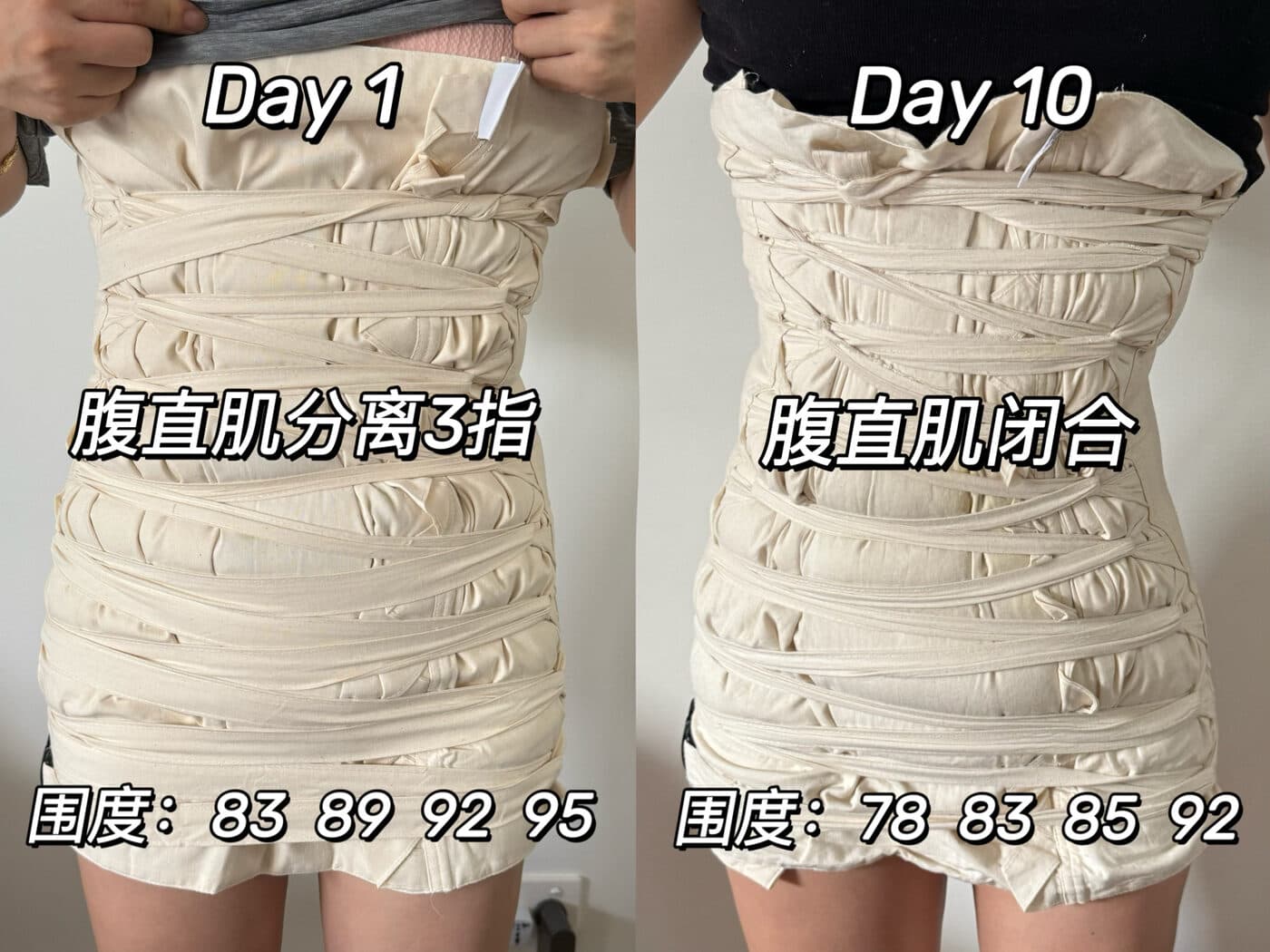 同一位妈妈扎肚第 1 天与第 10 天的对比