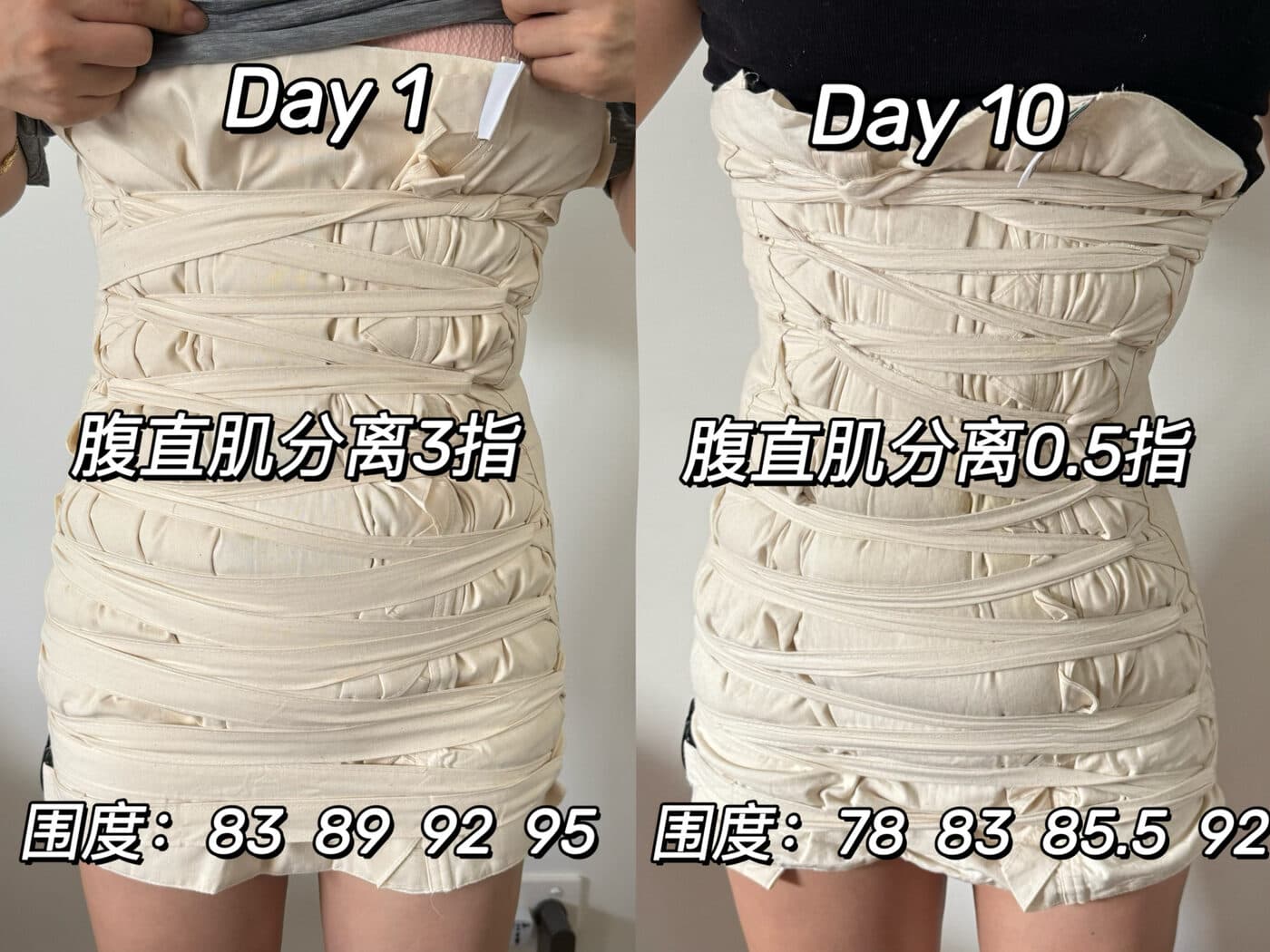 同一位妈妈扎肚第 1 天与第 10 天的对比