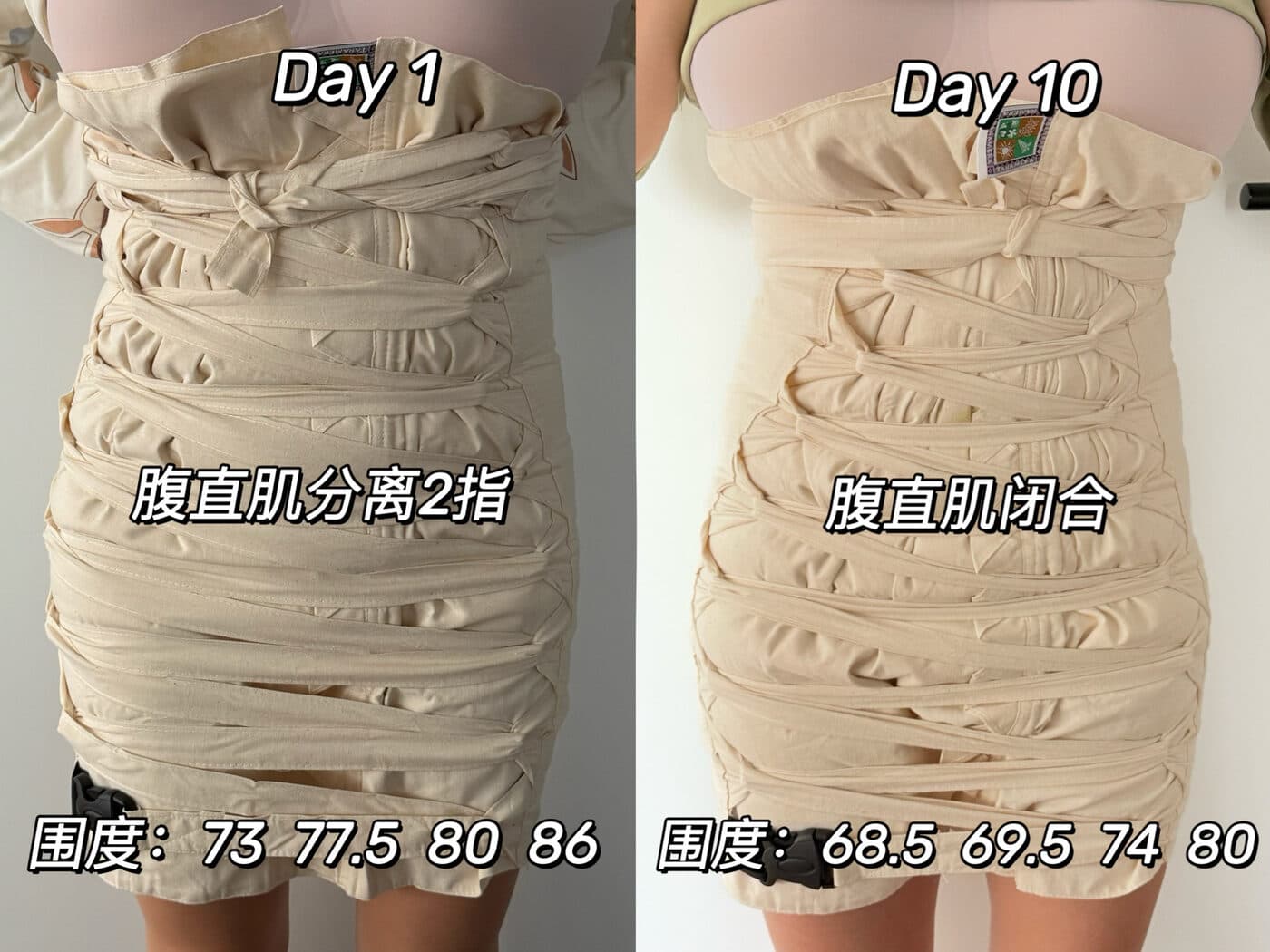 同一位妈妈扎肚第 1 天与第 10 天的对比