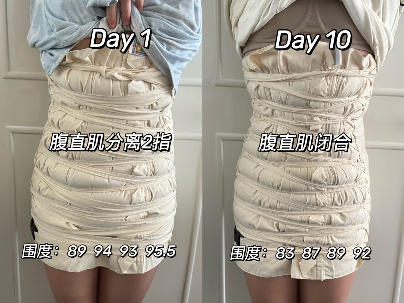 同一位妈妈扎肚第 1 天与第 10 天的对比