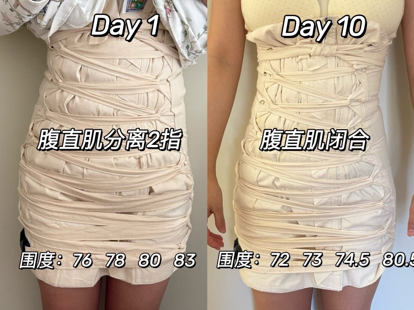 同一位妈妈扎肚第 1 天与第 10 天的对比