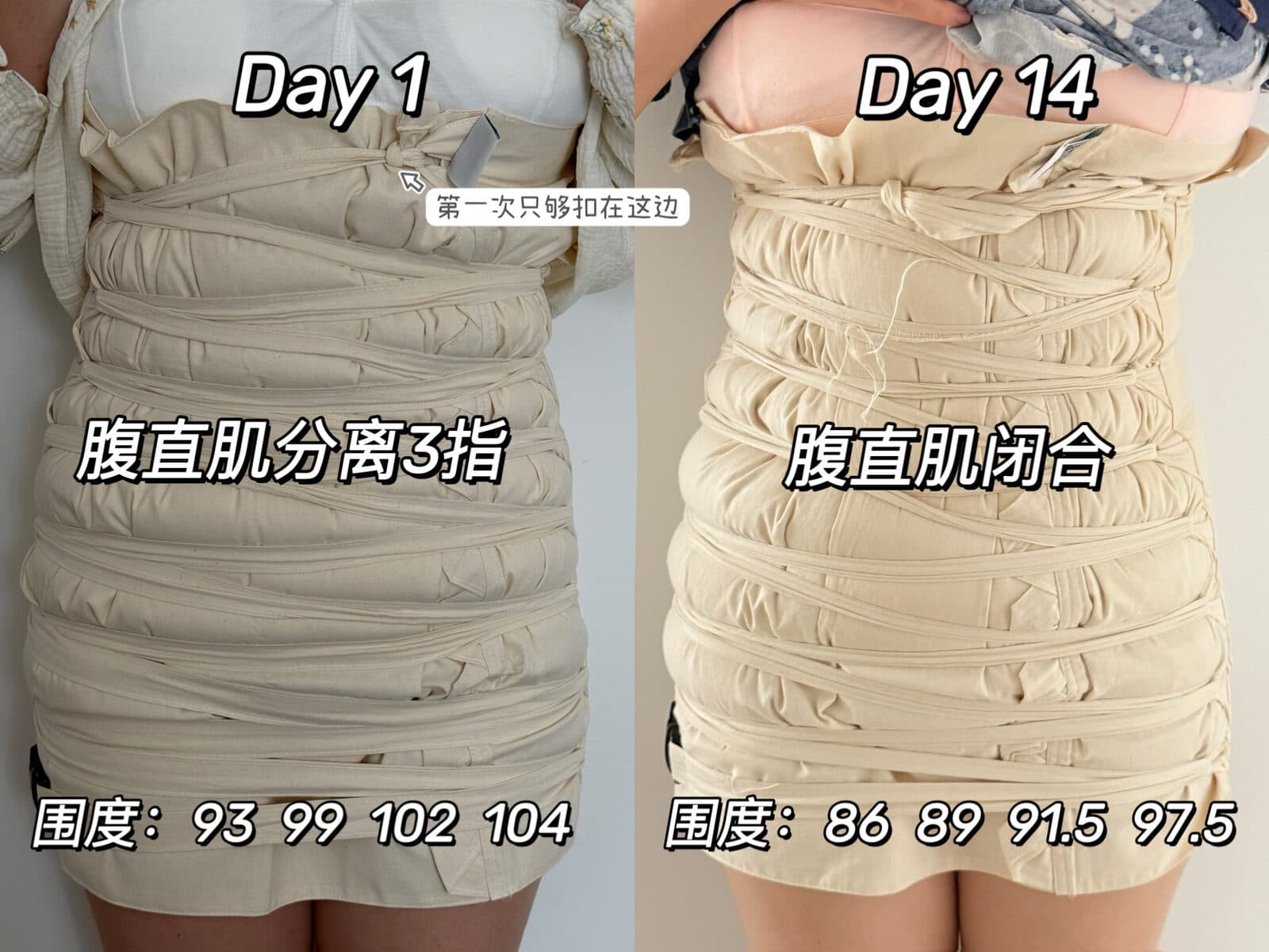同一位妈妈扎肚第 1 天与第 14 天对比:腹直肌分离 3 指至闭合,围度同步下降