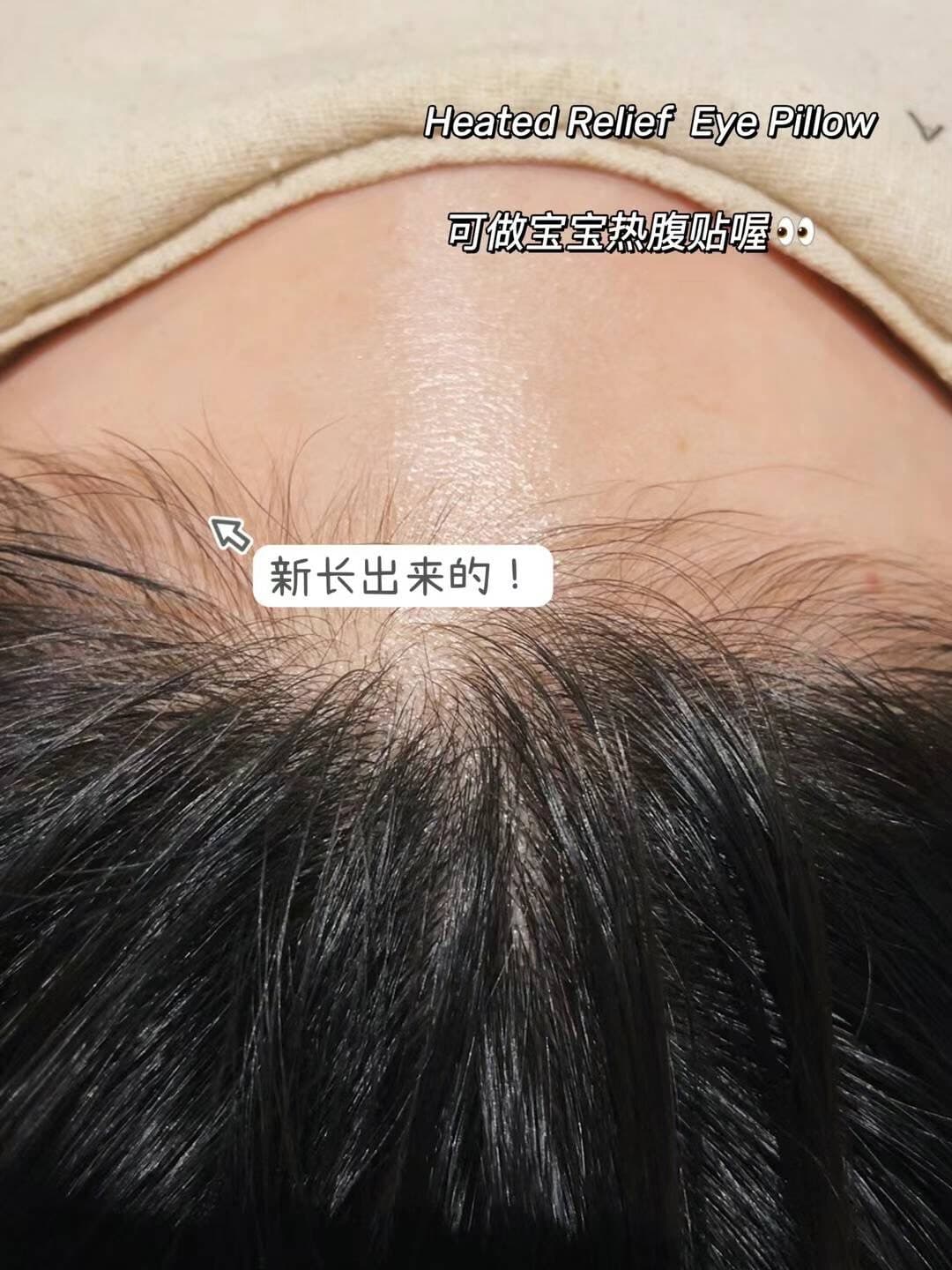 产后发际线特写,可见新长出的短发茬